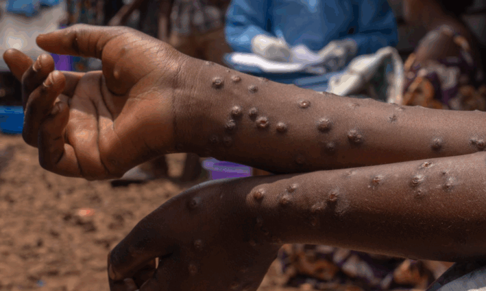 Mpox cases hit 880 as Ghana Health Service urges public to stay alert